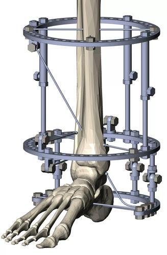High-precision bone and joint components for medical devices