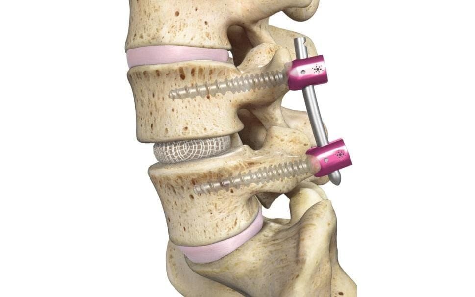 CNC-machined spinal fusion devices